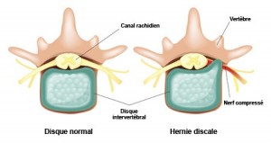 hernie, chiropratique dagenais,
